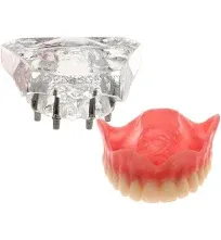 DEBKSGEOTI Dental Implant Typodont Restoration Teeth Model M6001 Clear Overdenture 4 Implants Superior Upper Demo for Study Teach