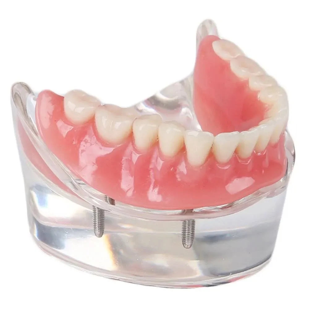 SOARDAY Dental Restoration Model with 4 implants Overdenture Inferior Teachin...